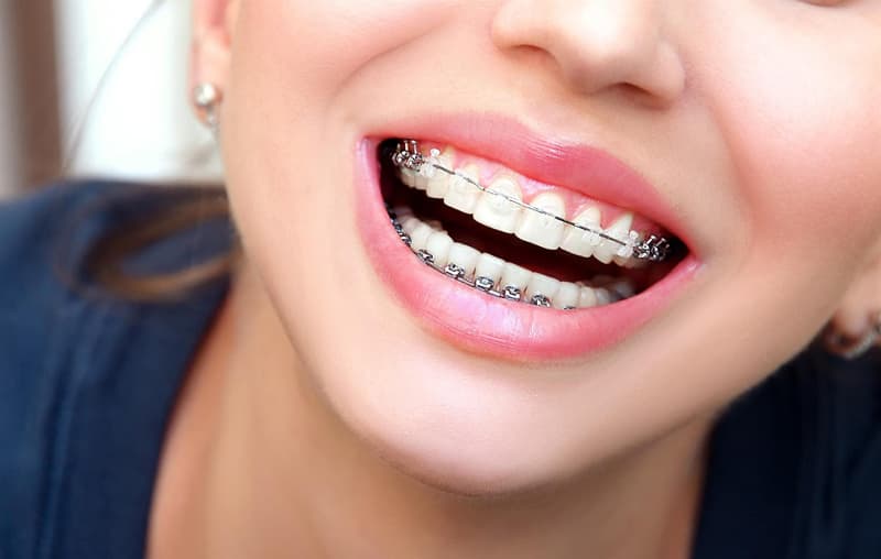 Conozca los beneficios de los brackets estéticos con Clínica Val