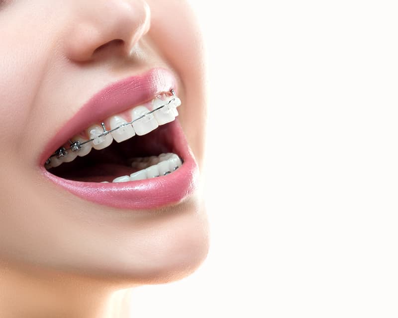 Brackets de porcelana en Ourense